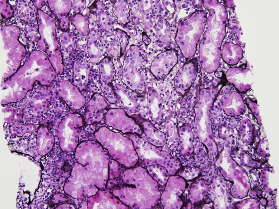 Acute cellular rejection (T-cell mediated, type I) with interstitial lymphocytic infiltrate, foci of moderate tubulitis, and interstitial edema (Jones silver stain).