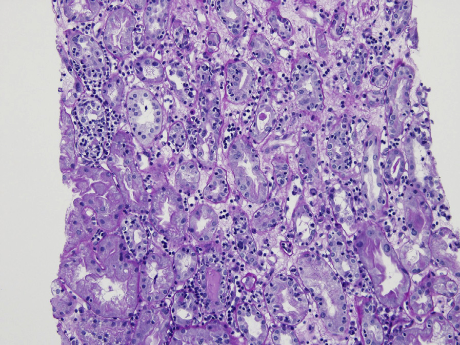Acute cellular rejection (T-cell mediated, type I) with interstitial lymphocytic infiltrate, foci of severe tubulitis, and interstitial edema (periodic acid–Schiff stain).