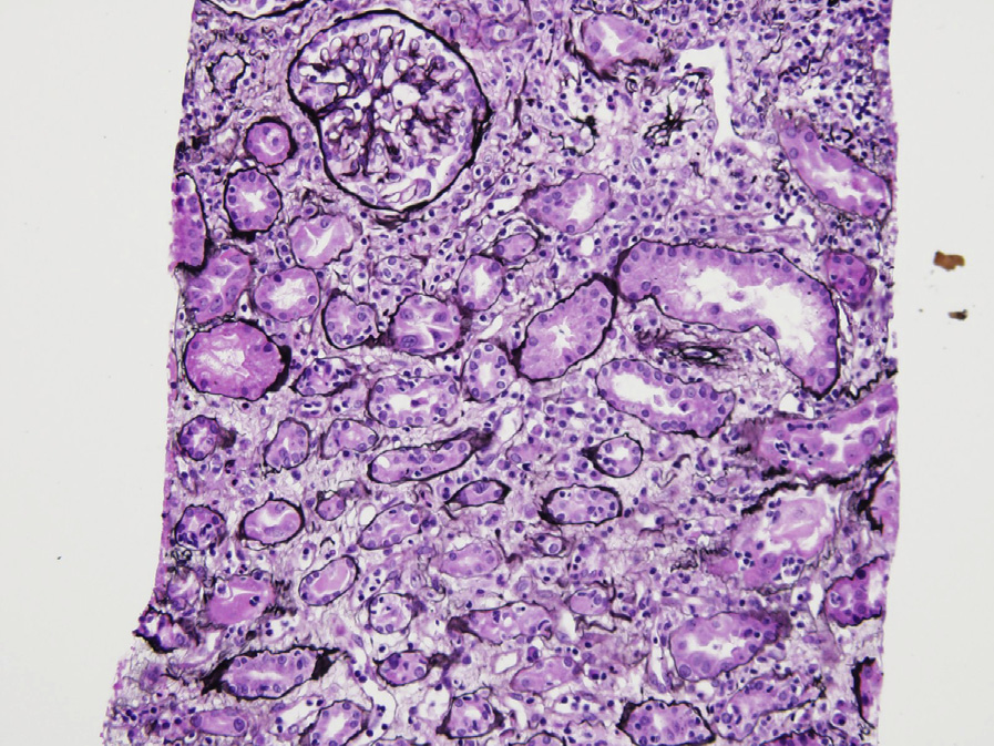 Acute cellular rejection (T-cell mediated, type I) with interstitial lymphocytic infiltrate, foci of mild tubulitis, and interstitial edema (Jones silver stain).