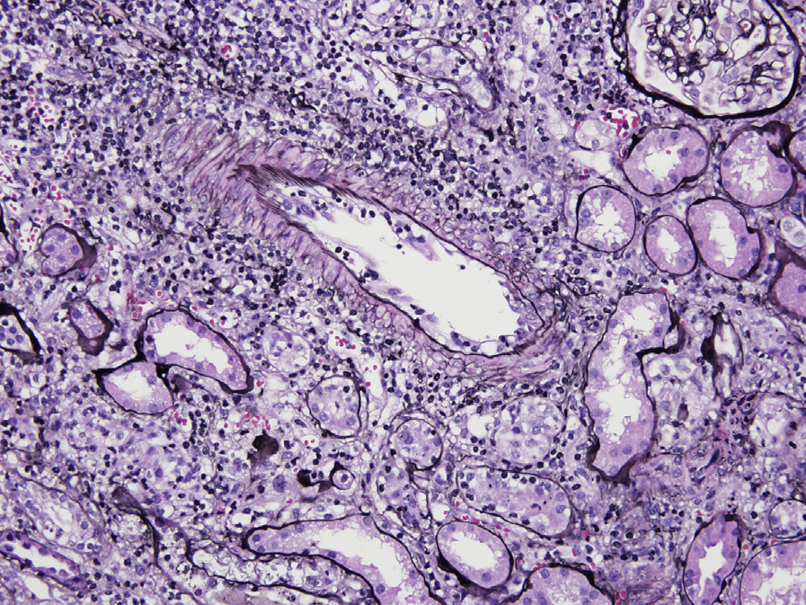 Acute cellular rejection (T-cell mediated, type II), also called acute vascular rejection, with interstitial lymphocytic infiltrate, foci of moderate tubulitis, and endothelialitis of an interlobular artery (Jones silver stain).