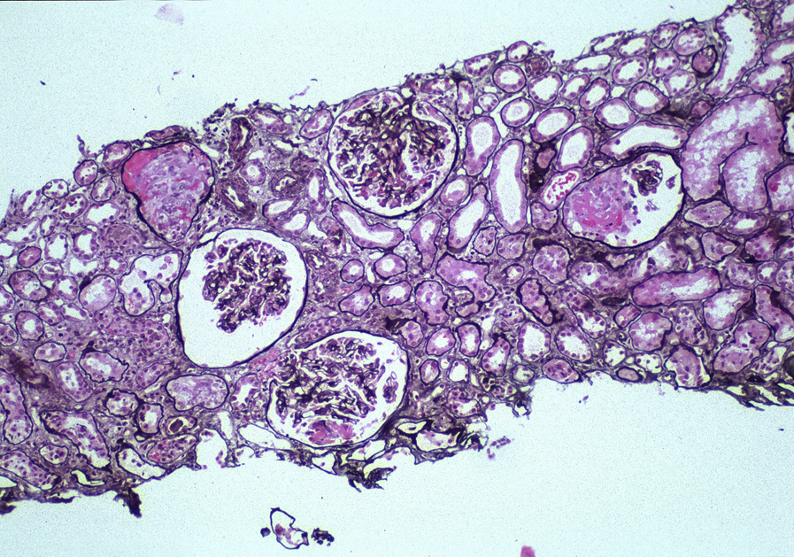 Anti–glomerular basement membrane antibody–mediated glomerulonephritis with focal segmental fibrinoid necrosis in glomeruli without proliferation or evidence of immune complex deposits (Jones silver stain). Reproduced with permission from AJKD 32(3):e1-e2.