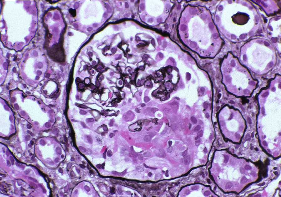 Anti–glomerular basement membrane antibody–mediated glomerulonephritis with early cellular crescent and fibrinoid necrosis without endocapillary hypercellularity or evidence of immune complex deposits (Jones silver stain). Reproduced with permission from AJKD 32(3):e1-e2.