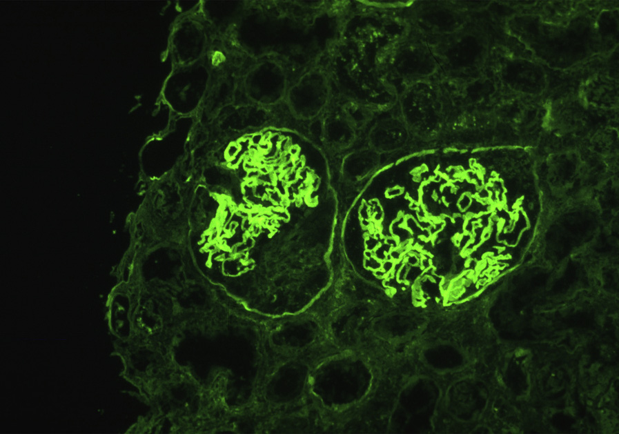 Anti–glomerular basement membrane antibody–mediated glomerulonephritis with linear staining of glomerular basement membranes with antibody to IgG and crescent formation in the glomerulus on the left (immunofluorescence microscopy). Reproduced with permission from AJKD 32(3):e1-e2.