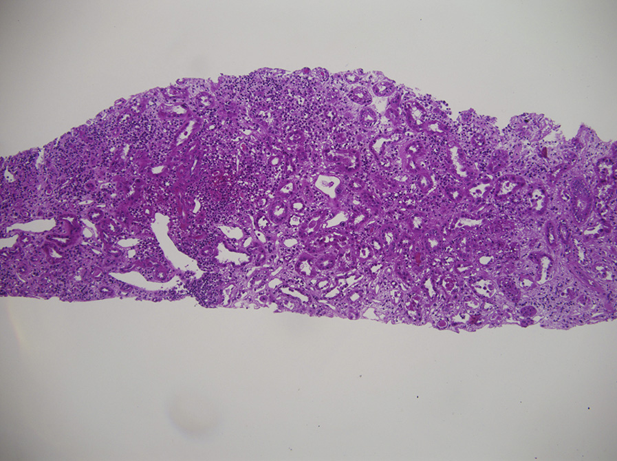 Anti–tubular basement membrane disease with diffuse interstitial lymphocytic infiltrate, with occasional plasma cells and eosinophils associated with tubulitis and mild interstitial edema (hematoxylin and eosin stain).