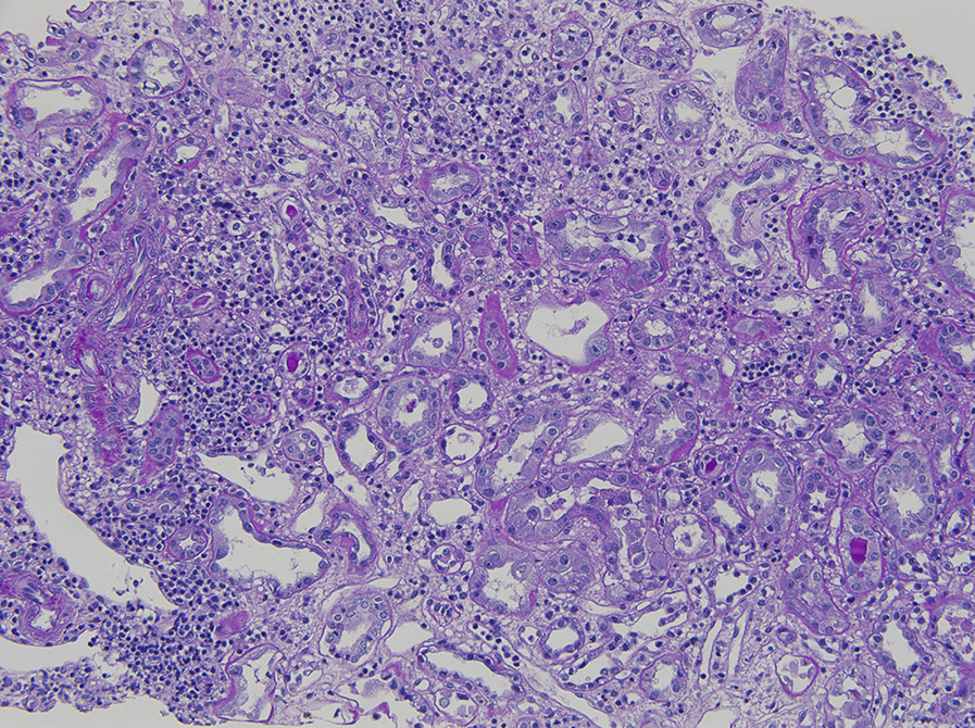 Anti–tubular basement membrane disease with interstitial lymphocytic infiltrate, with rare eosinophils associated with tubulitis and mild interstitial edema (periodic acid–Schiff stain).