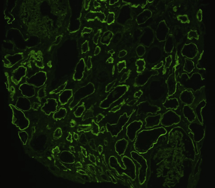 Anti–tubular basement membrane disease with strong smooth linear staining of tubular basement membranes without glomerular basement staining with antibody to IgG (immunofluorescence microscopy).