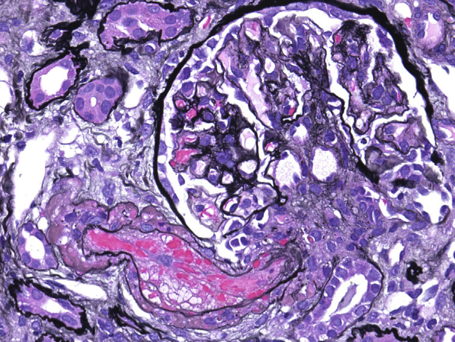 CNI nephrotoxicity with TMA involving an arteriole (Jones silver stain).
