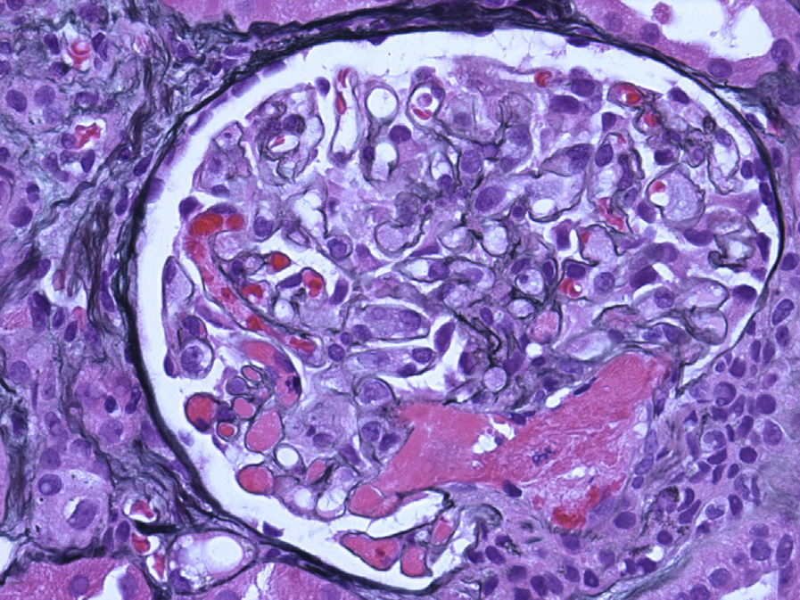 CNI nephrotoxicity with TMA involving the glomerular tuft and the vascular pole (Jones silver stain).