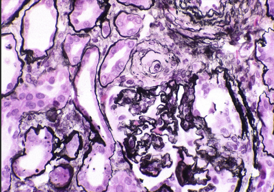 CNI nephrotoxicity with hyaline extending to the media of an arteriole and segmentally sclerosed glomerulus superimposed on ischemic change (Jones silver stain). Reproduced with permission from AJKD 36(1):e1-e2.