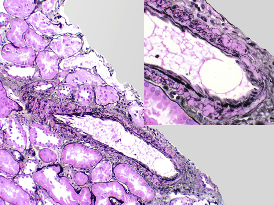 CNI nephrotoxicity with nodular hyalinosis extending to the media of an interlobular artery (Jones stain).