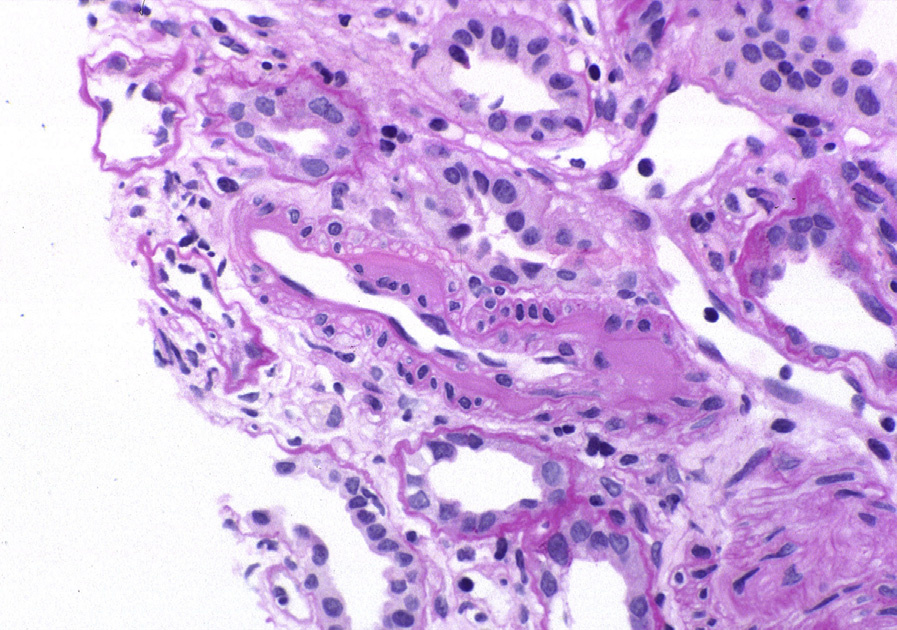 CNI nephrotoxicity with nodular hyalinosis extending to the media of an arteriole (periodic acid–Schiff stain). Reproduced with permission from AJKD 36(1):e1-e2.