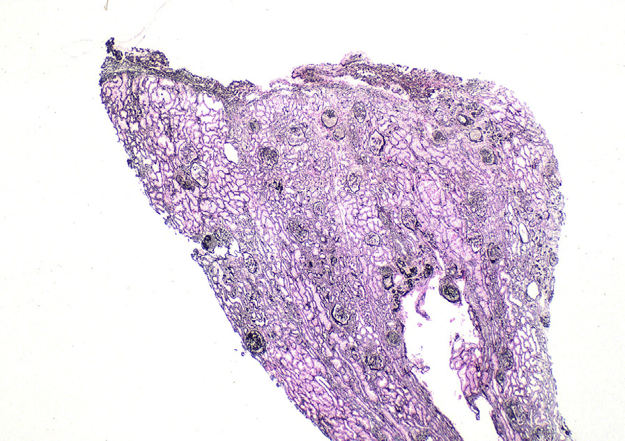 CNI nephrotoxicity with striped interstitial fibrosis (Jones silver stain). Reproduced with permission from AJKD 36(1):e1-e2.
