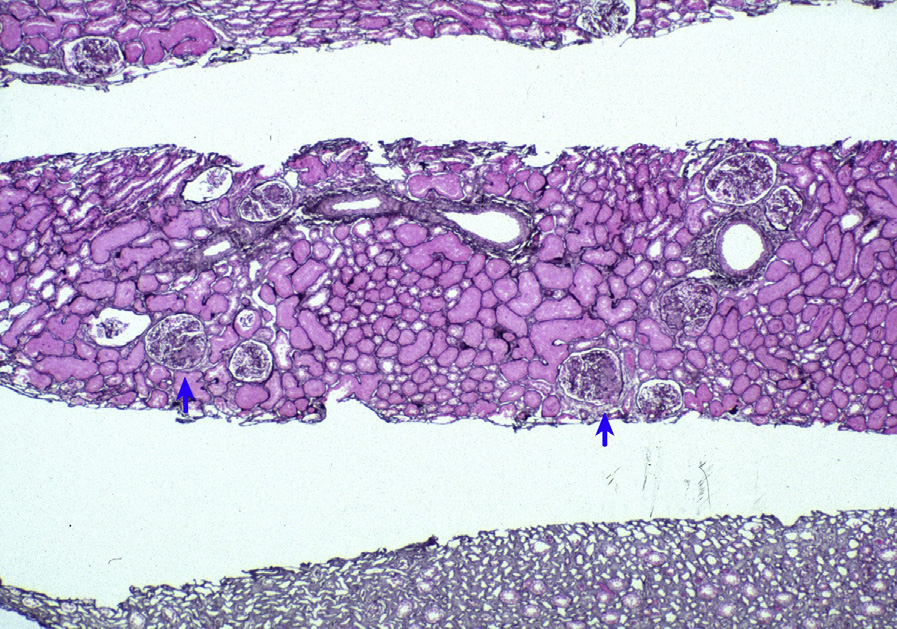 Focal lupus nephritis ISN/RPS class III with focal (<50%) glomerular involvement with active lesions. Some glomeruli have only minor mesangial expansion, whereas others have marked segmental endocapillary hypercellularity and even necrosis (blue arrow) (Jones silver stain). Adapted from AJKD 31(6):e1-e2.2. e10
