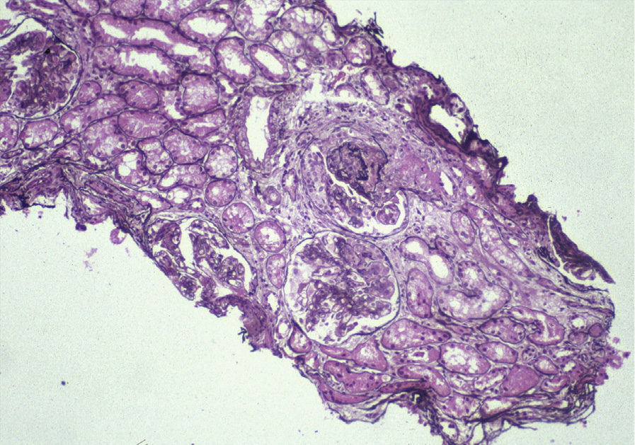 Diffuse lupus nephritis ISN/RPS class IV with diffuse (≥50%) glomerular involvement with active lesions. Most glomeruli have mild mesangial expansion and mild segmental endocapillary hypercellularity. One glomerulus has marked segmental hypercellularity and small cellular crescent with rupture of Bowman capsule and necrosis extending to the arteriole (Jones silver stain). Adapted from AJKD 31(6):e1-e2.2.