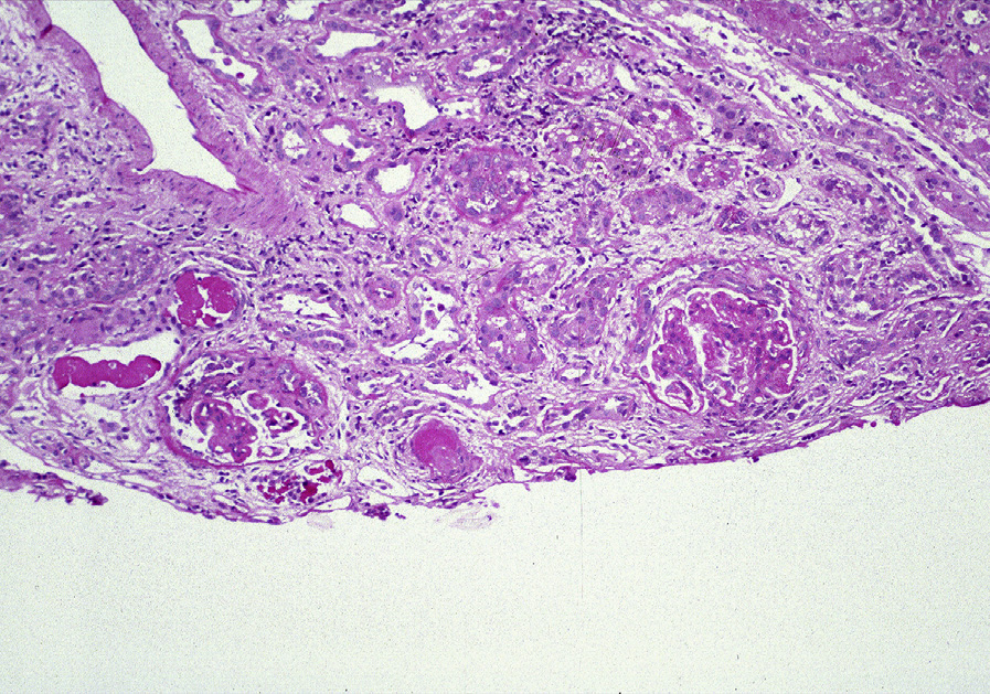 Diffuse lupus nephritis ISN/RPS class IV with chronicity with moderate interstitial fibrosis, glomerulosclerosis, and fibrocellular crescent, and activity with segmental endocapillary hypercellularity (periodic acid–Schiff stain). Adapted from AJKD 31(6):e1-e2.2.