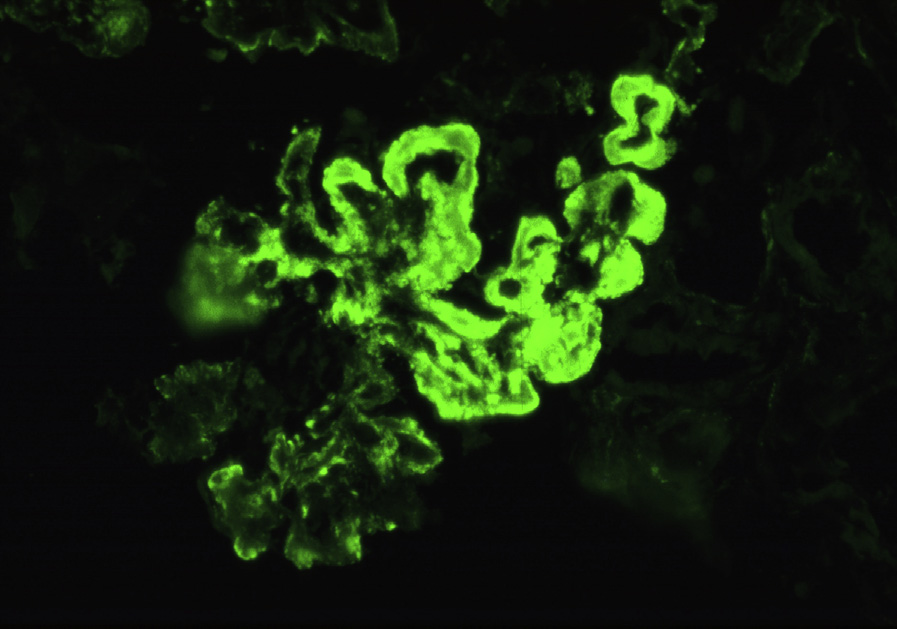 Diffuse lupus nephritis ISN/RPS class IV with sausage-shaped capillary wall deposits with smooth outer contours, indicative of subendothelial deposits, and scattered small granular capillary walls deposits, likely subepithelial deposits, and occasional mesangial deposits (immunofluorescence microscopy, IgG). Adapted from AJKD 31(6):e1-e2.2.
