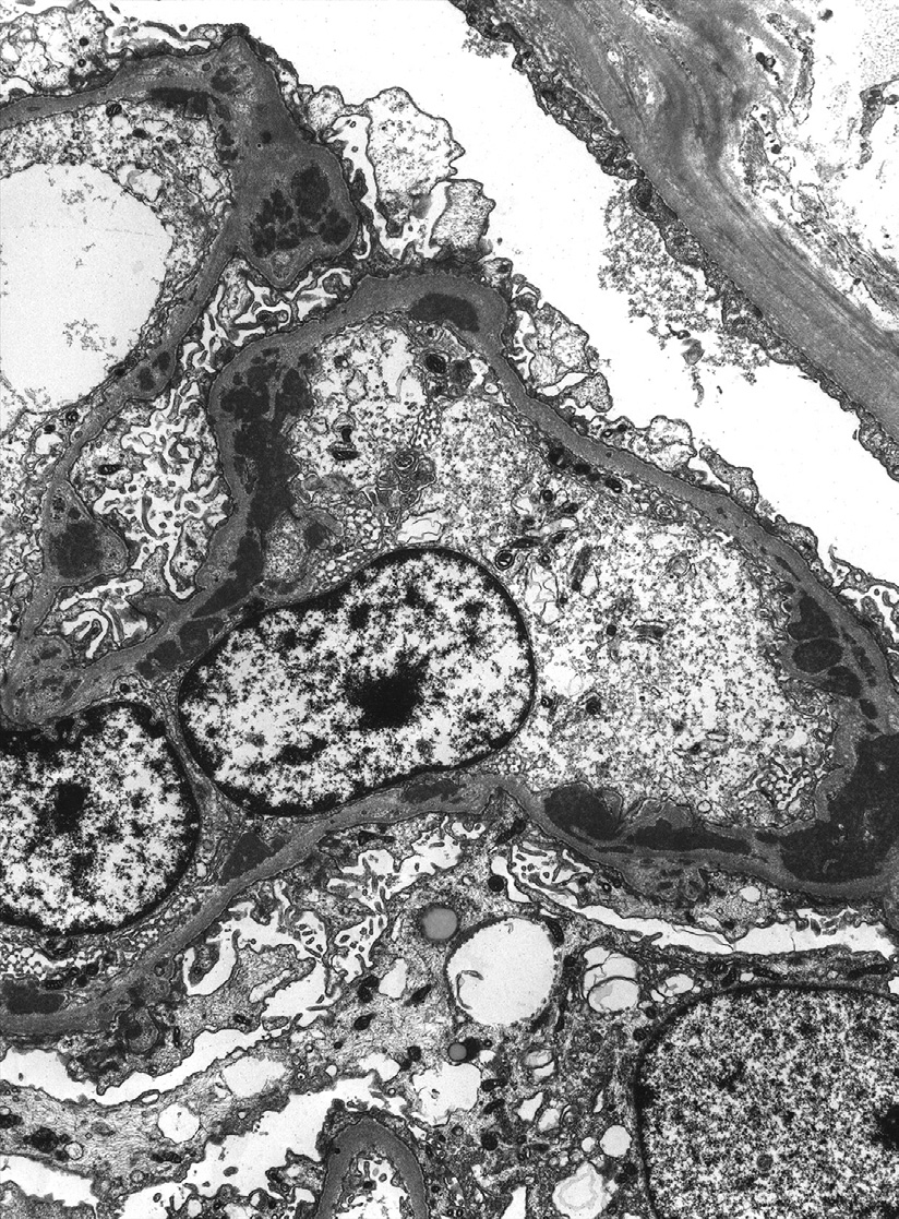 Diffuse lupus nephritis ISN/RPS class IV with subepithelial and subendothelial deposits (electron microscopy). Mesangial deposits are not shown in this image. Adapted from AJKD 31(6):e1-e2.2.