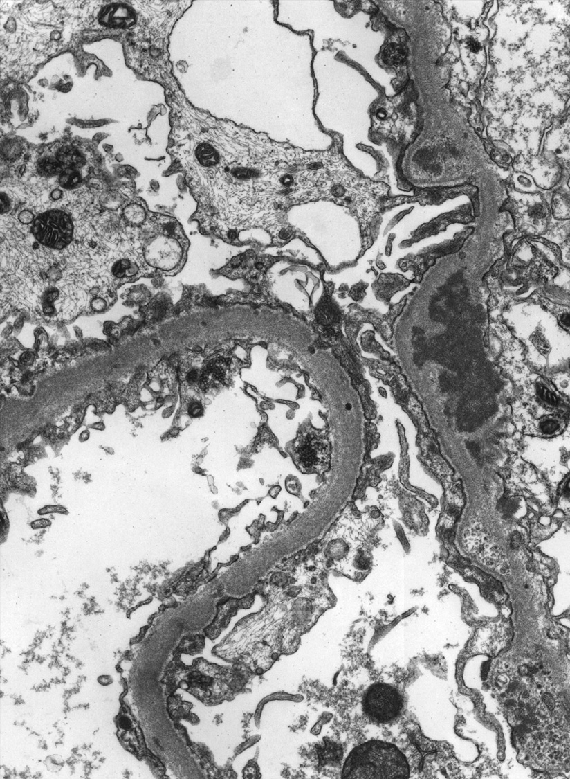 Diffuse lupus nephritis ISN/RPS class III with subendothelial, intramembranous, and subepithelial deposits with reticular aggregates within endothelial cell cytoplasm (electron microscopy). Adapted from AJKD 31(6):e1-e2.2.