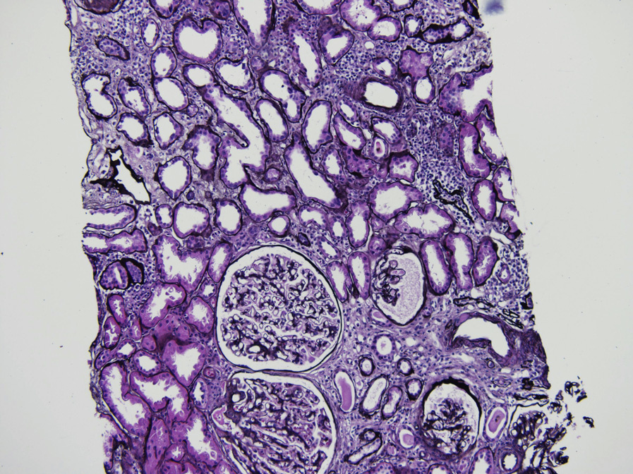 Sjögren syndrome with interstitial lymphoplasmacytic infiltrate involving areas of interstitial fibrosis and tubular atrophy (Jones silver stain).