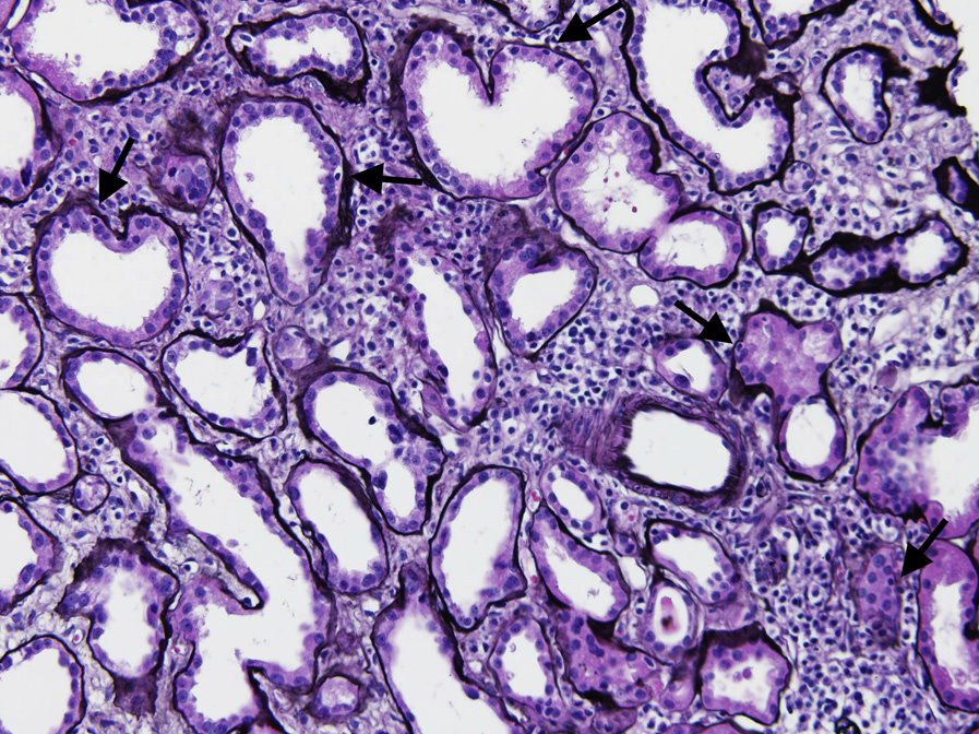 Sjögren syndrome with interstitial lymphoplasmacytic infiltrate with tubulitis (arrows) involving areas of interstitial fibrosis and tubular atrophy (Jones silver stain).