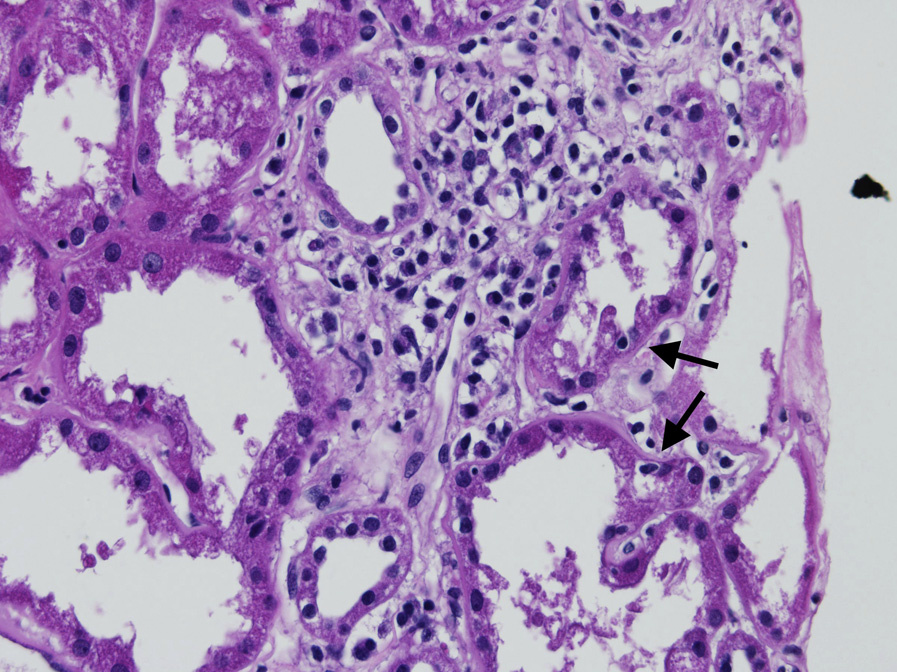 Sjögren syndrome with interstitial lymphoplasmacytic infiltrate with tubulitis (arrows) involving areas of interstitial fibrosis (hematoxylin and eosin stain).