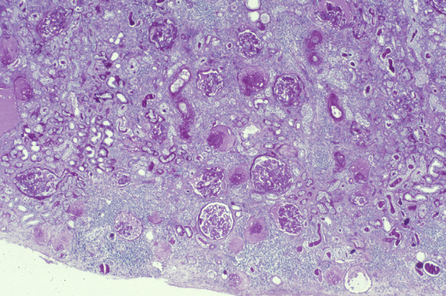 Kidney transplant IF/TA with glomerulosclerosis and interstitial fibrosis with proportional tubular atrophy and arterial intimal fibrosis (periodic acid–Schiff stain). Reproduced with permission from AJKD 41(1):e29-e30.