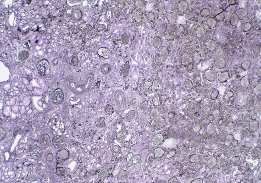 Kidney transplant IF/TA with widespread global glomerulosclerosis, interstitial fibrosis with proportional tubular atrophy, and arterial intimal fibrosis (Jones silver stain). Reproduced with permission from AJKD 41(1):e29-e30.