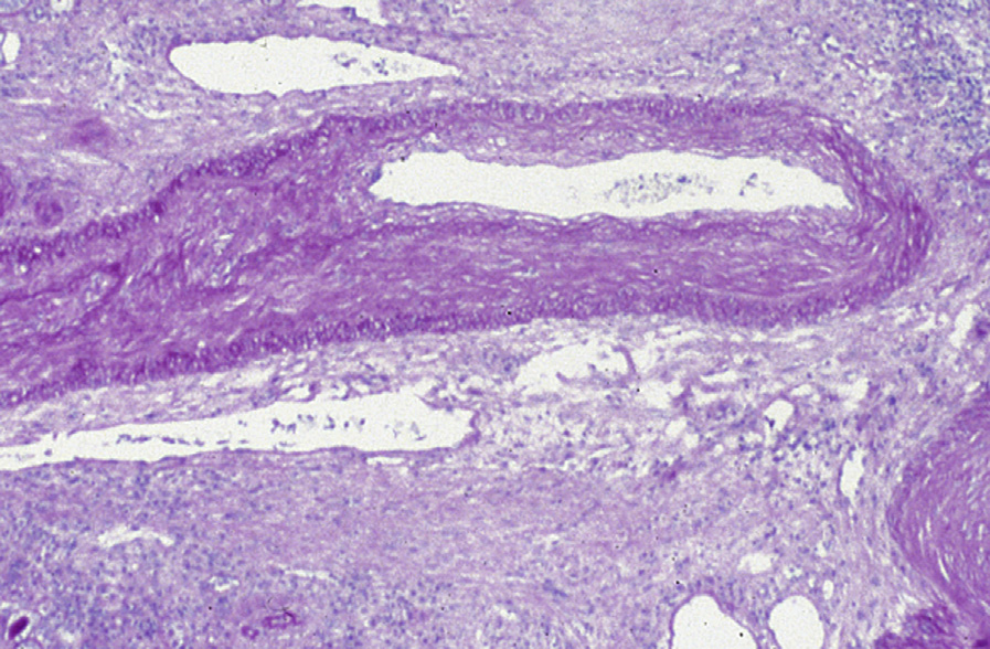 Kidney transplant IF/TA with widespread severe intimal fibrosis and medial thickening (periodic acid–Schiff stain). Reproduced with permission from AJKD 41(1):e29-e30.