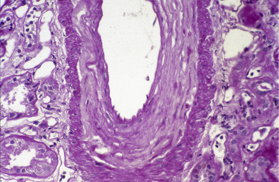Kidney transplant IF/TA with concentric duplication of the intima of a large artery (periodic acid–Schiff stain). Reproduced with permission from AJKD 41(1):e29-e30.