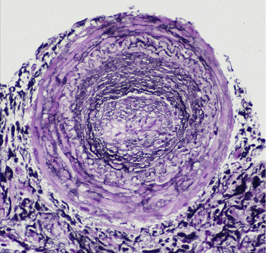 Kidney transplant IF/TA with concentric duplication of the intima of a large artery with superimposed endothelialitis and active and chronic transplant arteriopathy (Jones silver stain). Reproduced with permission from AJKD 41(1):e29-e30.