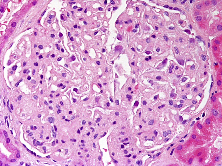 Lecithin–cholesterol acyltransferase deficiency with mild mesangial expansion with slight foamy appearance. Capillary walls show segmental thickening (hematoxylin and eosin stain).