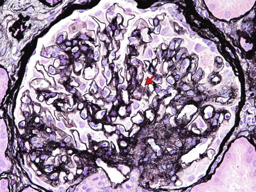 Lecithin–cholesterol acyltransferase deficiency with segmental thickening and duplication of capillary loops with mild mesangial expansion. Spiculation of glomerular basement membranes mimics membranous nephropathy (arrow). This glomerulus has segmental sclerosis (left) secondary to LCAT deficiency (Jones silver stain).