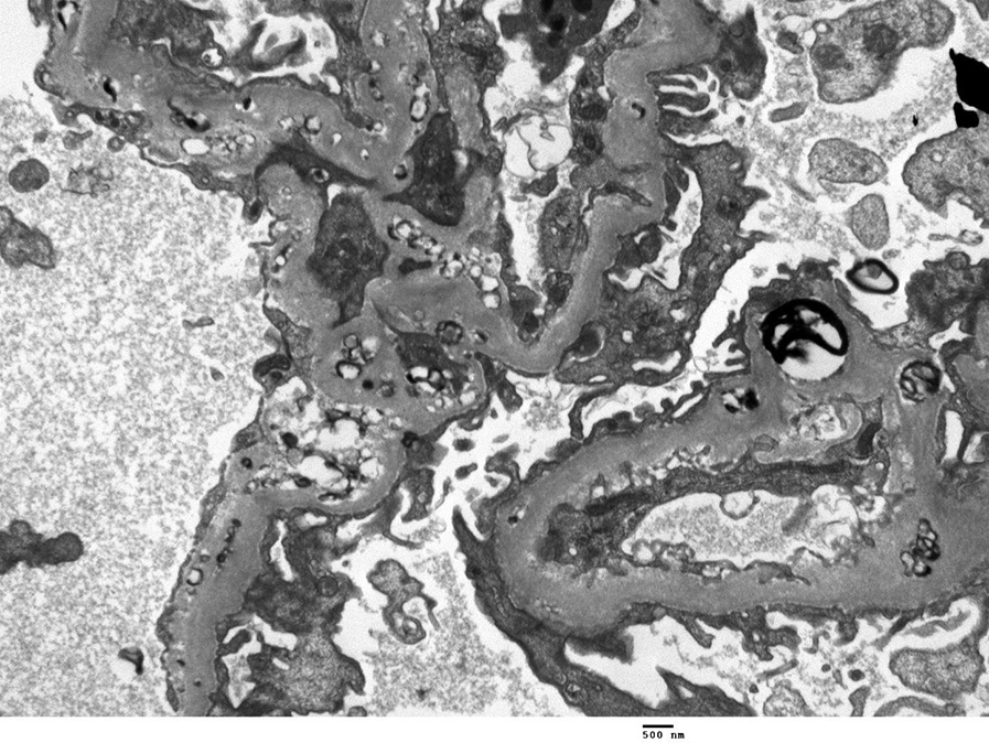 Lecithin–cholesterol acyltransferase deficiency with subepithelial, intramembranous, subendothelial and mesangial lipid deposits (electron microscopy).