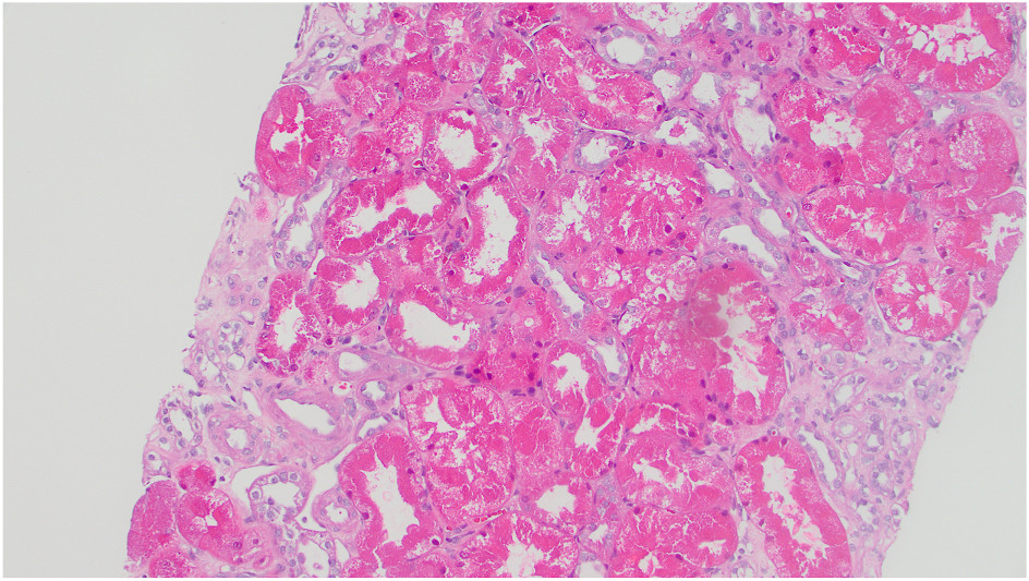 Diffuse hypereosinophilia of proximal tubules with acute tubular injury with vacuolization and blebbing (hematoxylin and eosin stain).