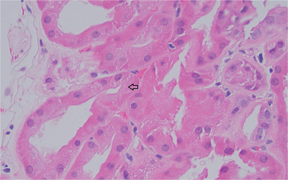 Diffuse large and round intracytoplasmic inclusions in proximal tubular cells (arrow) (hematoxylin and eosin stain).