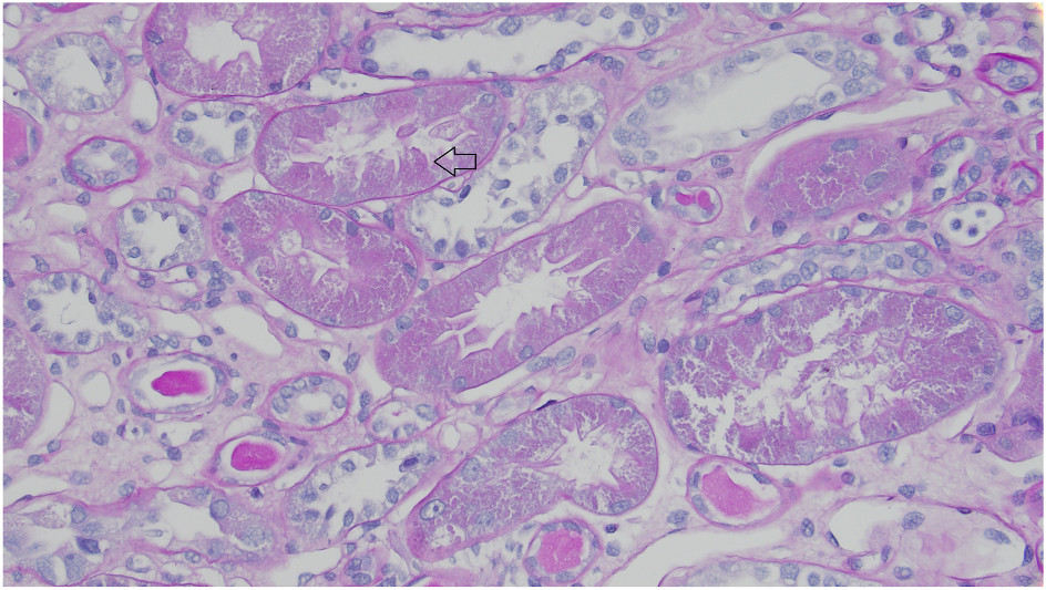Pale PAS inclusions within tubular epithelial cells (arrow), loss of brush border, and occasional proteinaceous casts (PAS stain).