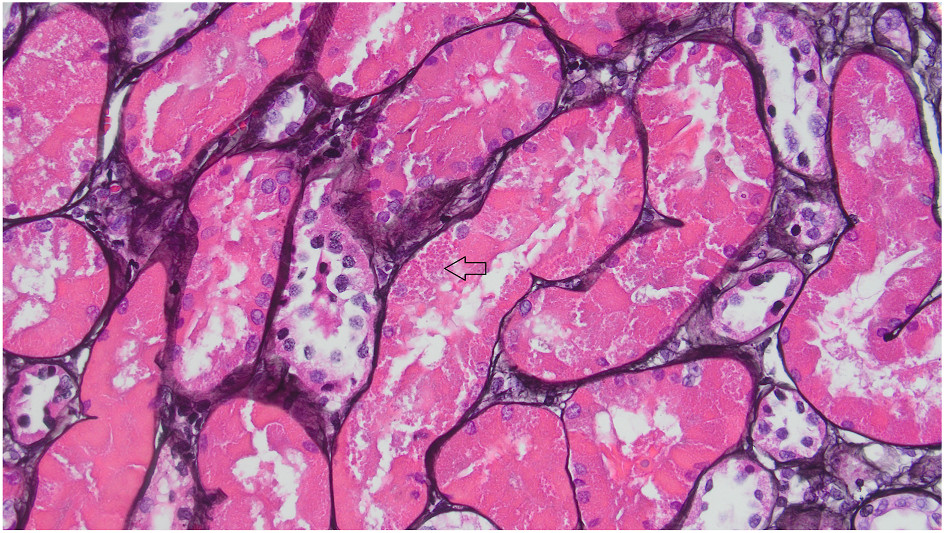 Silver-negative intracytoplasmic inclusions in proximal tubular cells (arrow) (Jones methenamine silver).