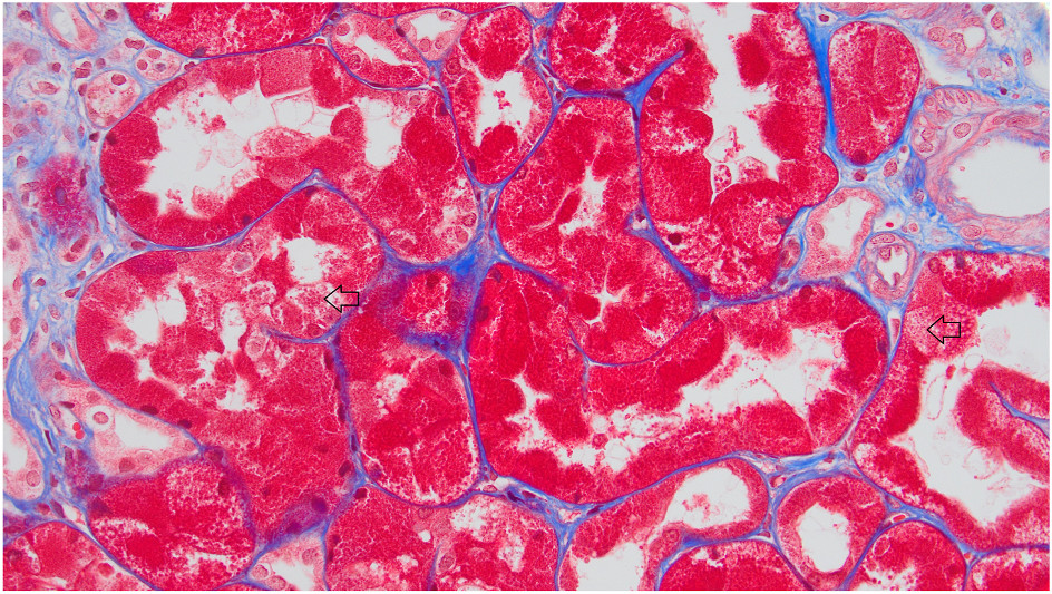 Fuchsinophilic intracytoplasmic inclusion body in proximal tubular cells (arrow) (Masson trichrome stain).
