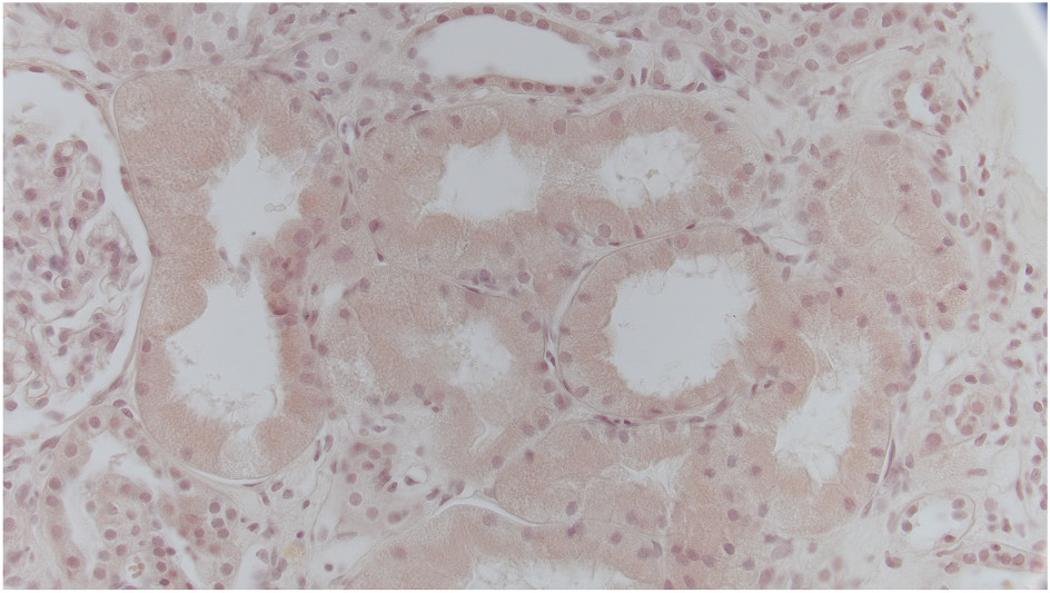 Congo red–negative intracytoplasmic inclusions in tubular cells (Congo red stain).
