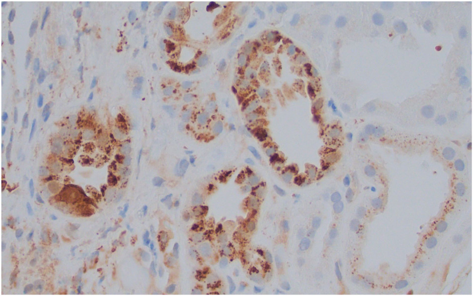 Diffuse lysozyme staining of intracytoplasmic inclusions (lysozyme immunostain).