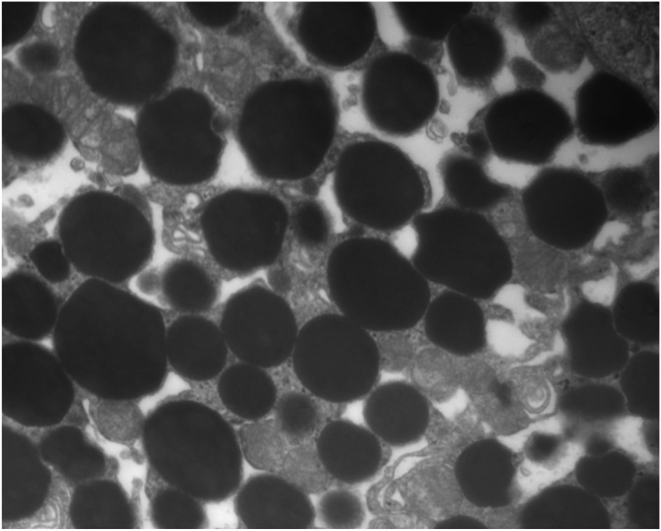Proximal tubule with intracytoplasmic, membrane-bound vacuoles containing homogenous uniform-dense material (transmission electron microscopy).