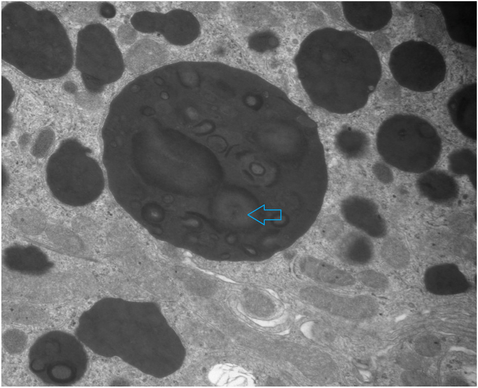 Curvilinear/circumferential materials with central lucent area in proximal tubule vacuoles (arrow) (transmission electron microscopy).