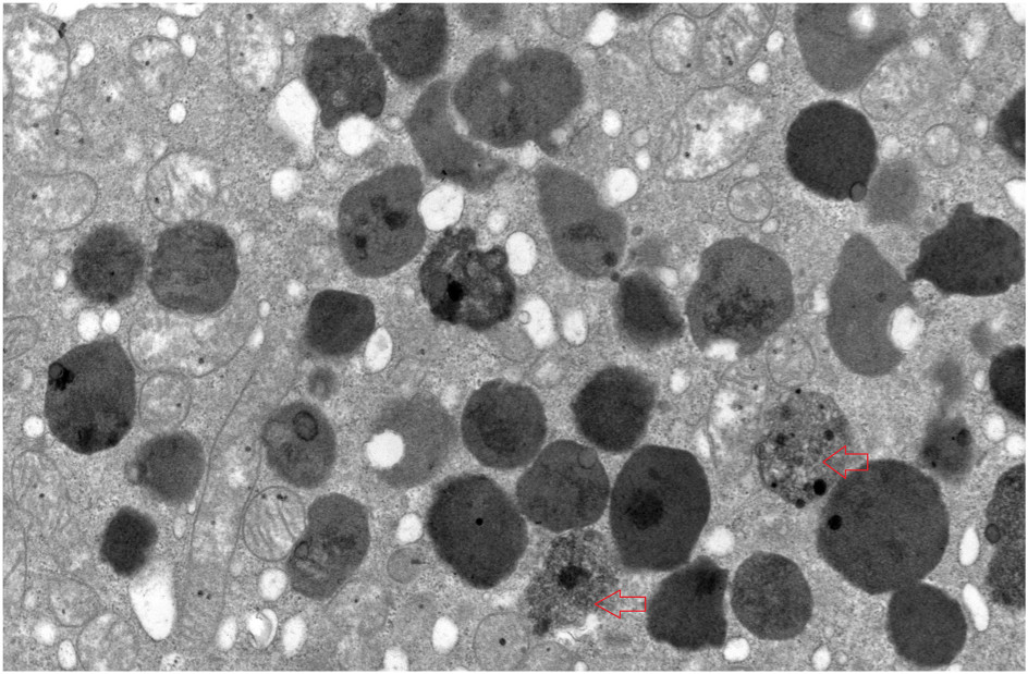 Vacuoles in proximal tubule containing granular electron densities (arrow) (transmission electron microscopy).e3