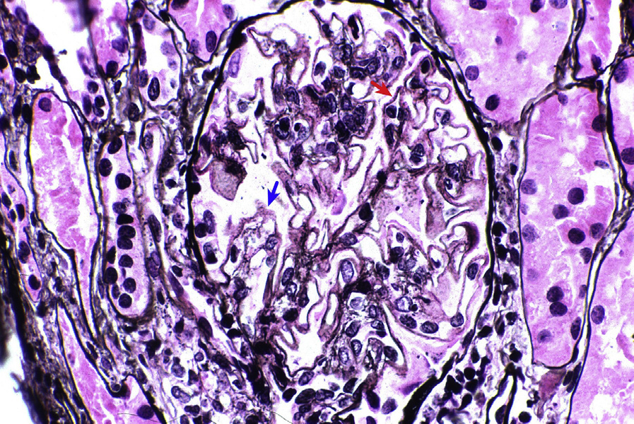 Membranous lupus nephritis ISN/RPS class V with diffuse holes (blue arrow) and small spikes (red arrow) along glomerular basement membranes with mild mesangial expansion and proliferation (Jones silver stain). Adapted with permission from AJKD 32(1):e1-e2.1.
