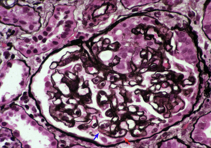 Membranous lupus nephritis ISN/RPS class V and focal lupus nephritis ISN/RPS class III with small spikes (red arrow) and holes (blue arrow) along glomerular basement membranes with contour duplication and early crescent formation (Jones silver stain). Adapted with permission from AJKD 32(1):e1-e2.1.