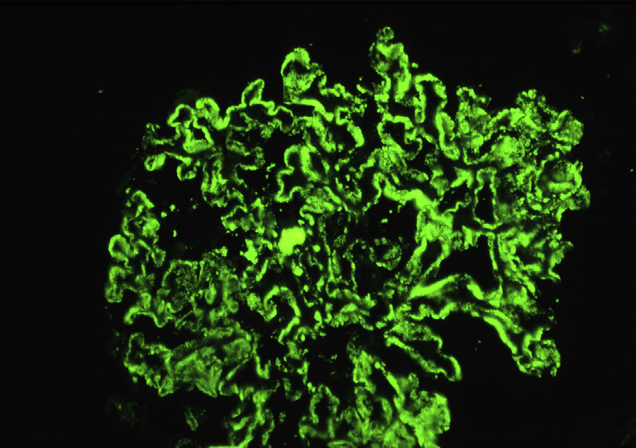 Membranous lupus nephritis ISN/RPS class V with diffuse global granular capillary loop and mesangial staining (immunofluorescence microscopy, IgG). Reproduced with permission from AJKD 32(1):e1-e2.1.