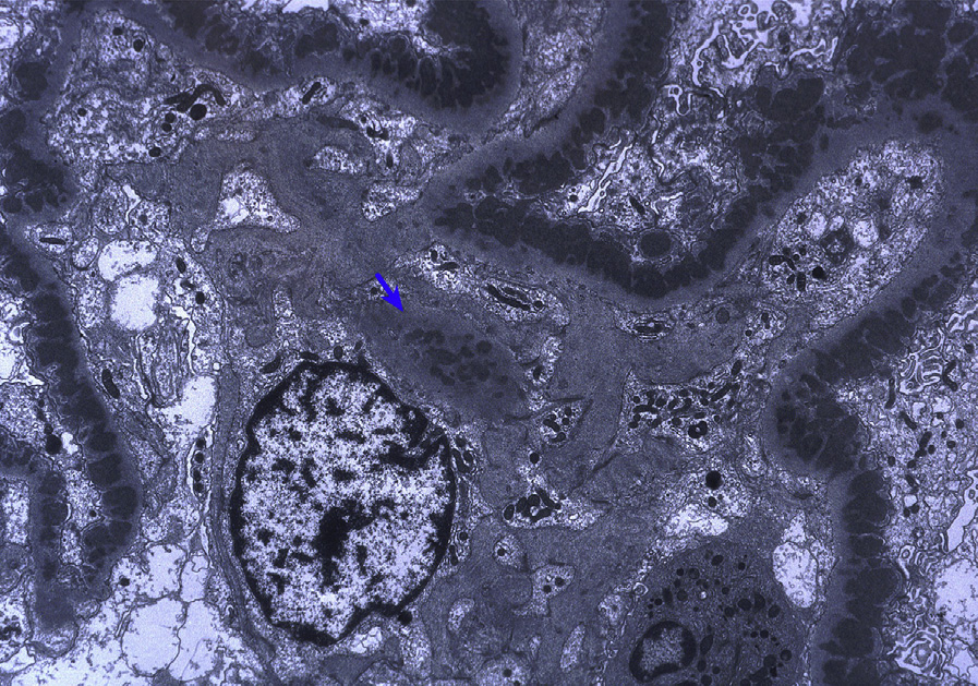 Membranous lupus nephritis ISN/RPS class V with frequent subepithelial with lesser mesangial deposits (blue arrow; electron microscopy). Adapted with permission from AJKD 32(1):e1-e2.1.