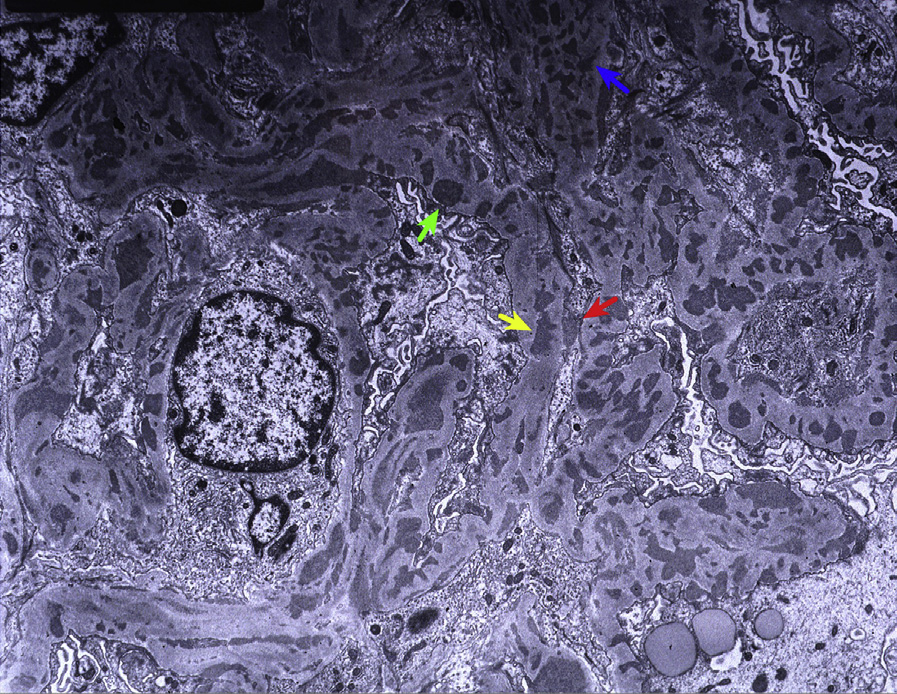 Membranous lupus nephritis ISN/RPS class V and diffuse lupus nephritis ISN/RPS class IV with numerous subepithelial (green arrow) and intramembranous (yellow arrow), frequent mesangial (blue arrow), and occasional subendothelial (red arrow) deposits with endocapillary hypercellularity (electron microscopy). Adapted with permission from AJKD 32(1):e1-e2.1.