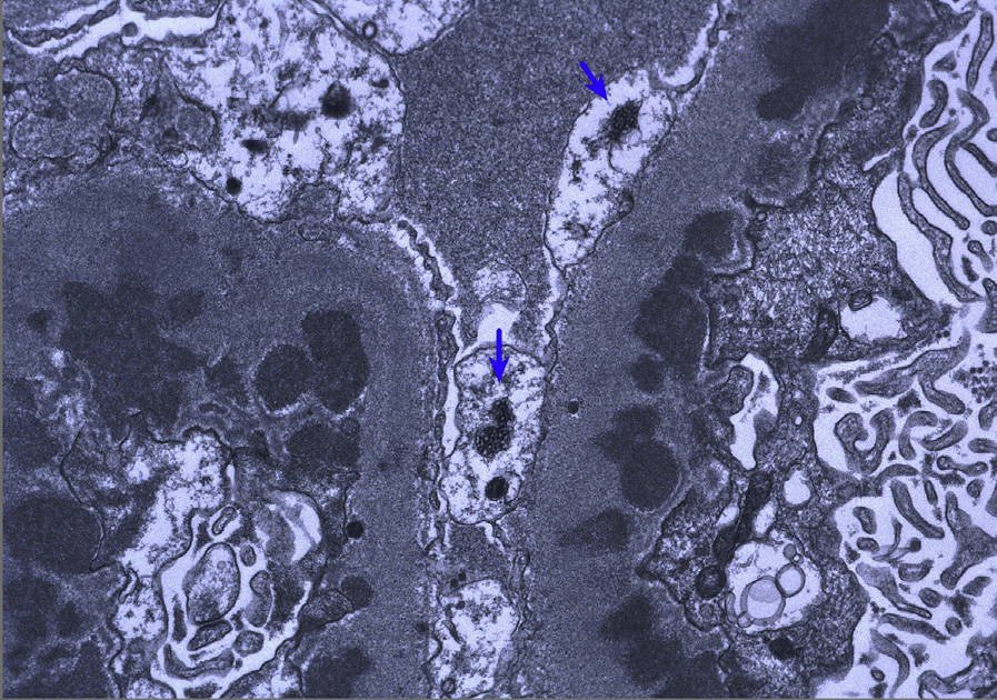 Membranous lupus nephritis ISN/RPS class V with subepithelial deposits and reticular aggregates (blue arrows) in the cytoplasm of endothelial cells (electron microscopy). Adapted with permission from AJKD 32(1):e1-e2.1.