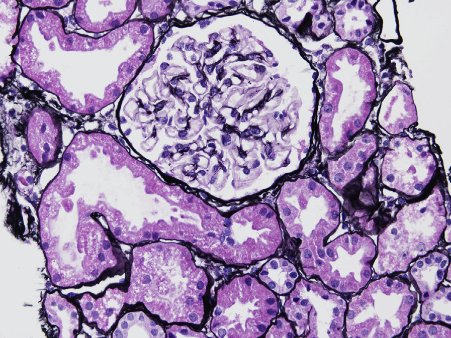 Minimal mesangial lupus nephritis ISN/RPS class I with no significant glomerular changes by light microscopy (Jones silver stain).